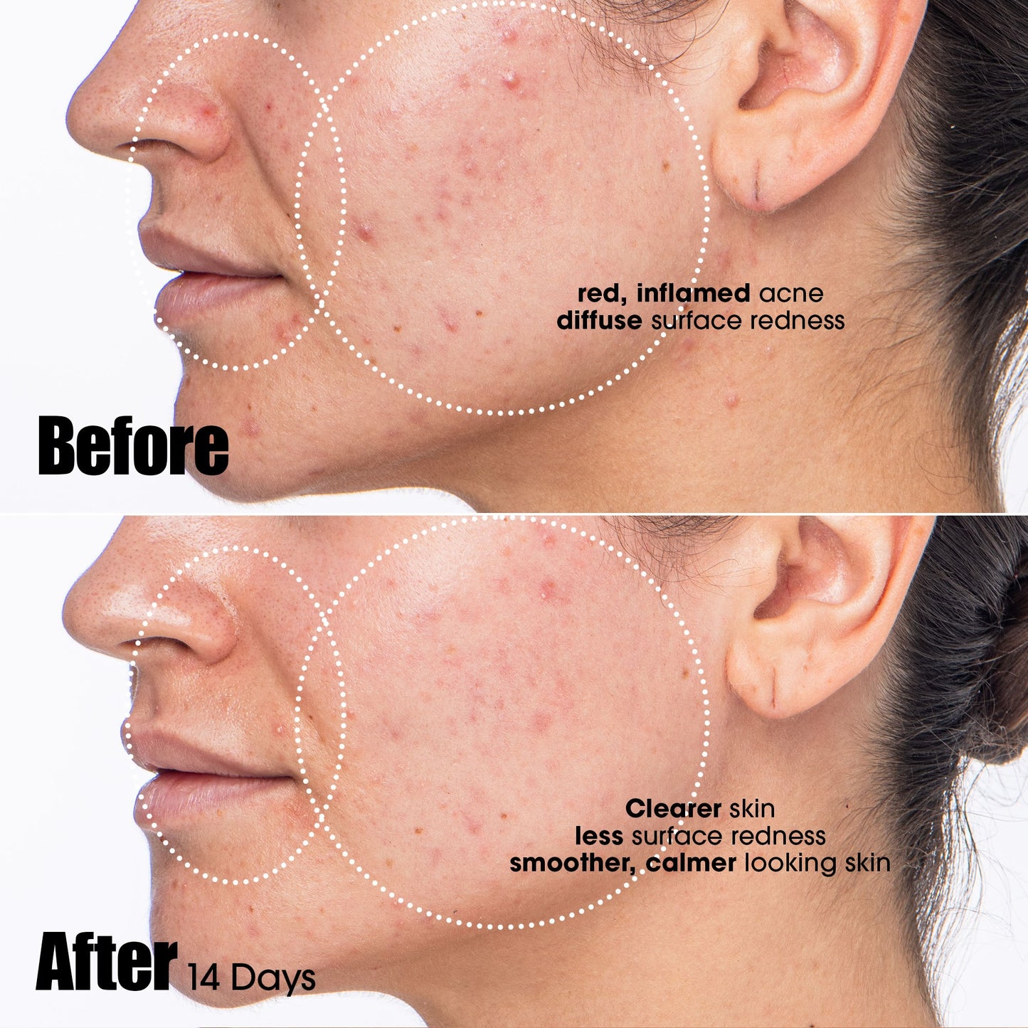 Peacekeeper Acne Treatment Serum