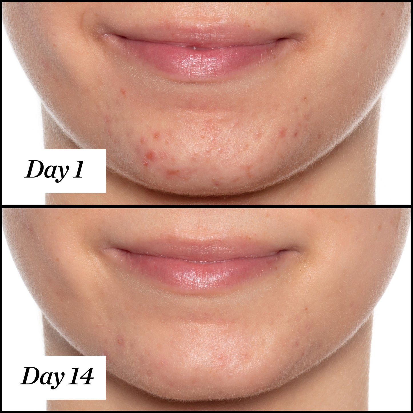 U.F.O. product usage, before and after results from day 1 to day 14. Clear and visible results; reduced redness and acne.