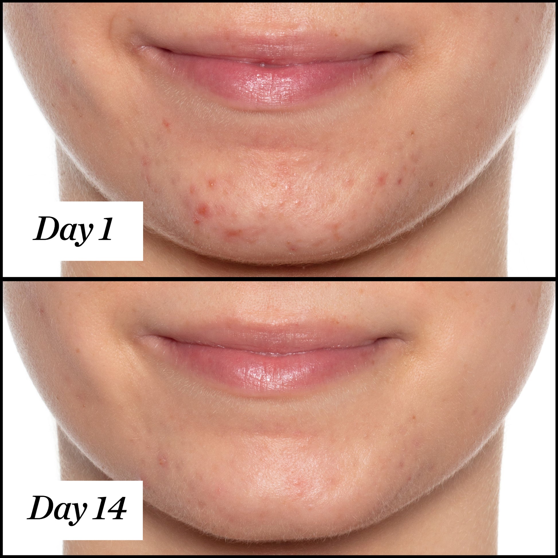 U.F.O. product usage, before and after results from day 1 to day 14. Clear and visible results; reduced redness and acne.