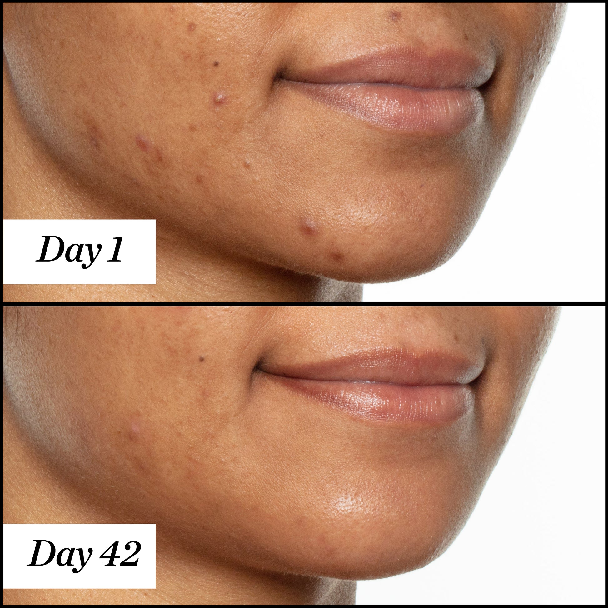 U.F.O. product usage, before and after results from day 1 to day 42 on dark skin. Clear and visible results; reduced redness and acne.