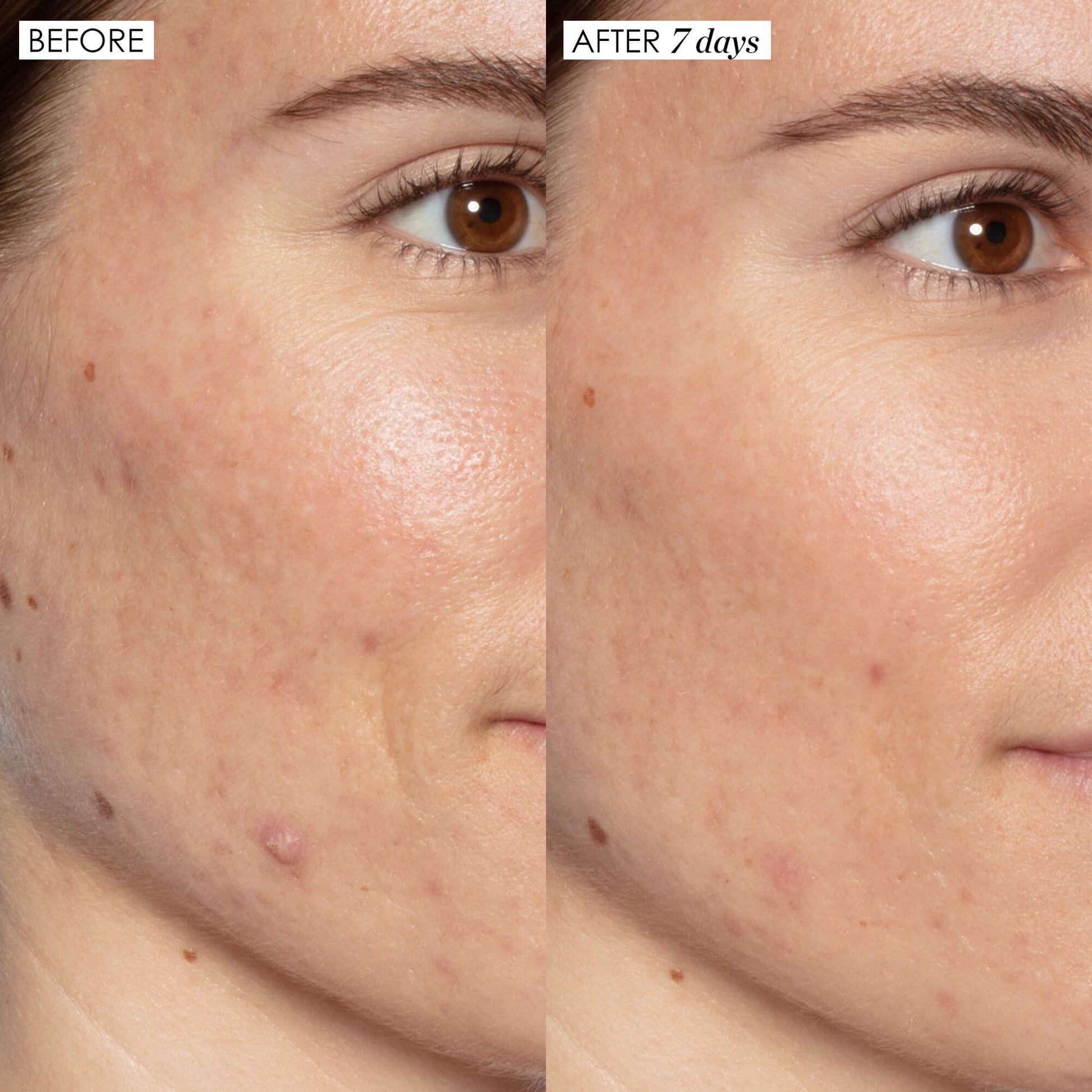 Good Genes before and after, face and cheek close up. Visually reduced the look of dark spots, dark spots, and discoloration caused by exposure to the sun 7 days of use