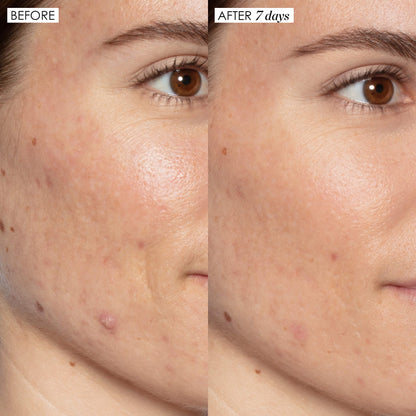 Good Genes before and after, face and cheek close up. Visually reduced the look of dark spots, dark spots, and discoloration caused by exposure to the sun 7 days of use