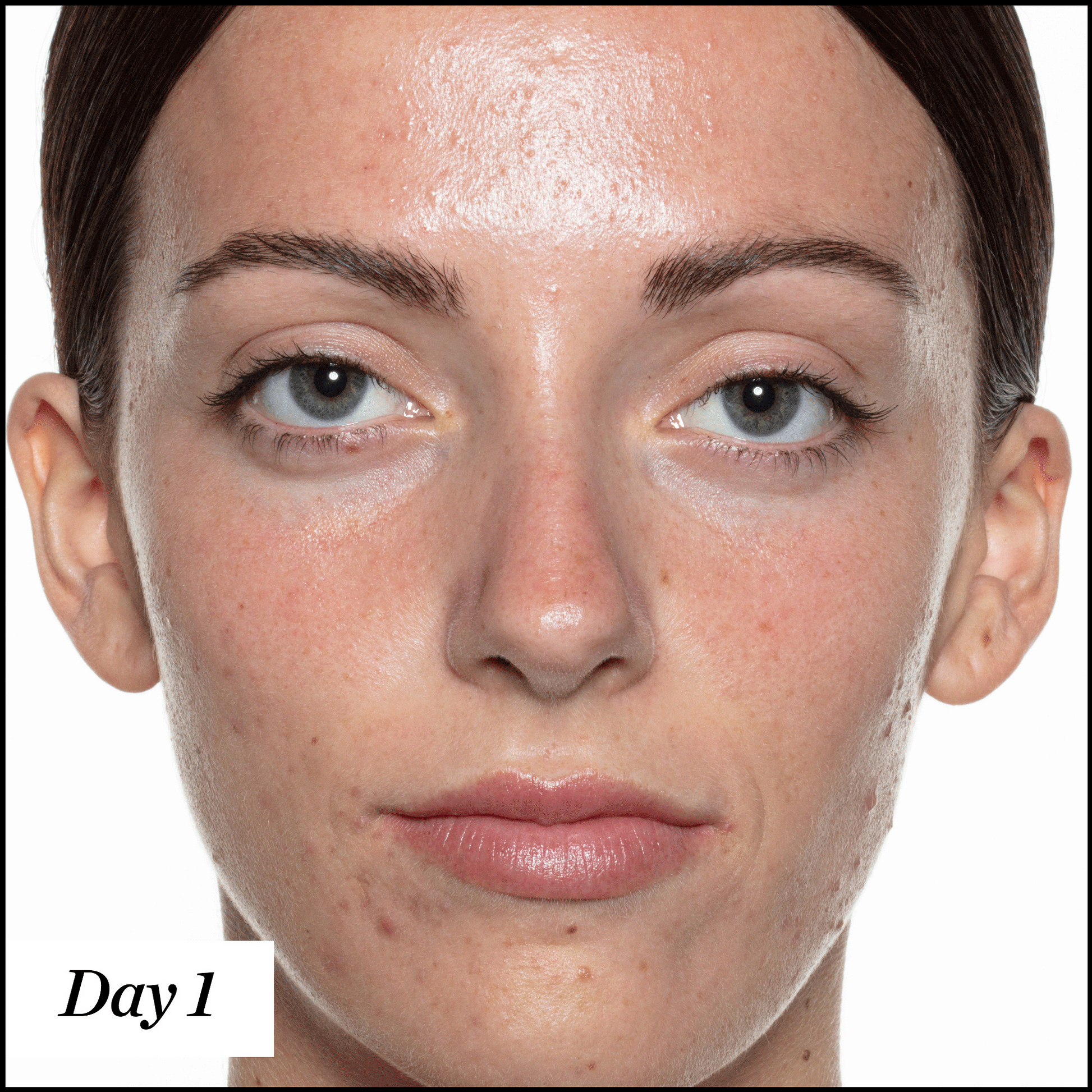 U.F.O. Acne Treatment Face Oil